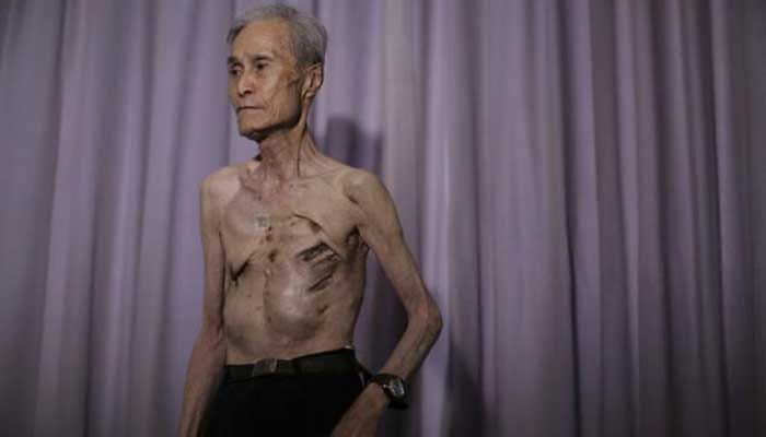 Kesan parut radiasi pada mangsa terselamat hibakusha